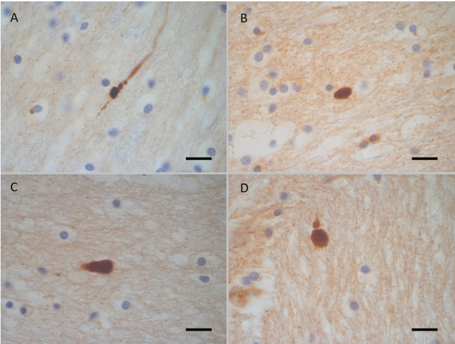 LNDBrainBank's tweet photo. Axonal injury is detected by ฮฒAPP immunohistochemistry in rapid death from head injury following road traffic collision
Keywords: #axonalinjury #IHC #headinjury #ฮฒAPP
https://t.co/MdgvKt7E6p https://t.co/jmrDd0quXK