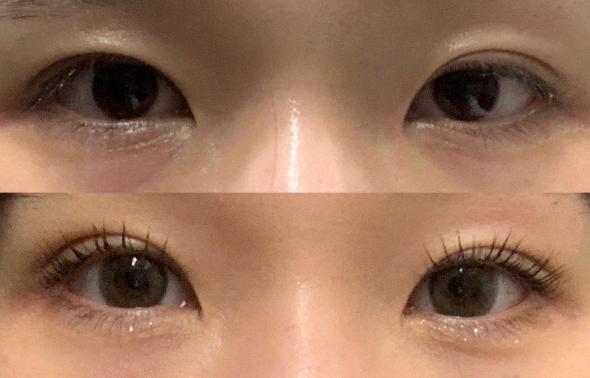 uyuiii20's tweet photo. 片目二重整形（右目）5日目！
上を見た時に目頭側が食い込むのが完全に無くなった！🥲
そしてまつげのキワが見えるようになった🥲
自然に左右対称になっててうれしい先生めっちゃ上手い、、！
自然癒着法・笑気麻酔代込みで10万いかないくらいでした。 https://t.co/tQnYJvFV30