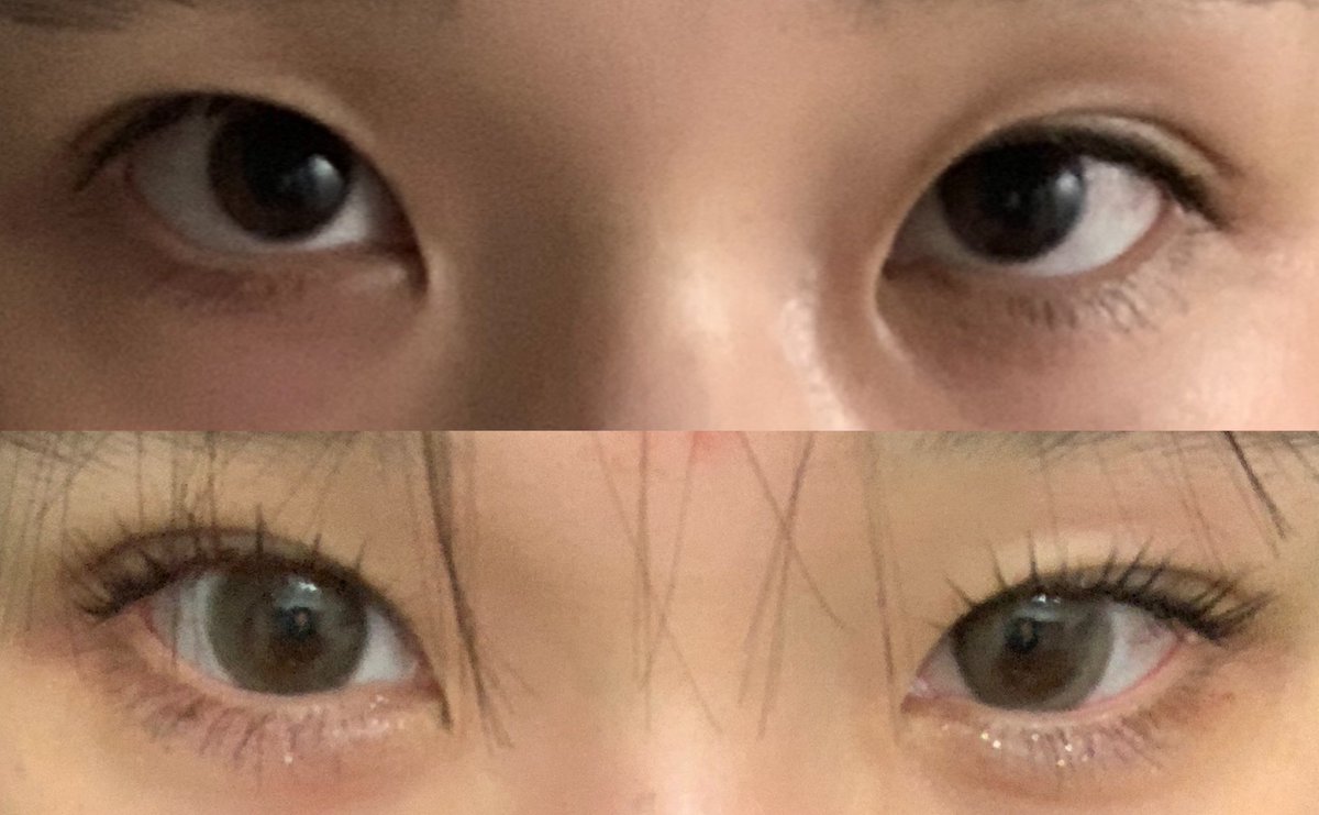 uyuiii20's tweet photo. 片目二重整形（右目）5日目！
上を見た時に目頭側が食い込むのが完全に無くなった！🥲
そしてまつげのキワが見えるようになった🥲
自然に左右対称になっててうれしい先生めっちゃ上手い、、！
自然癒着法・笑気麻酔代込みで10万いかないくらいでした。 https://t.co/tQnYJvFV30