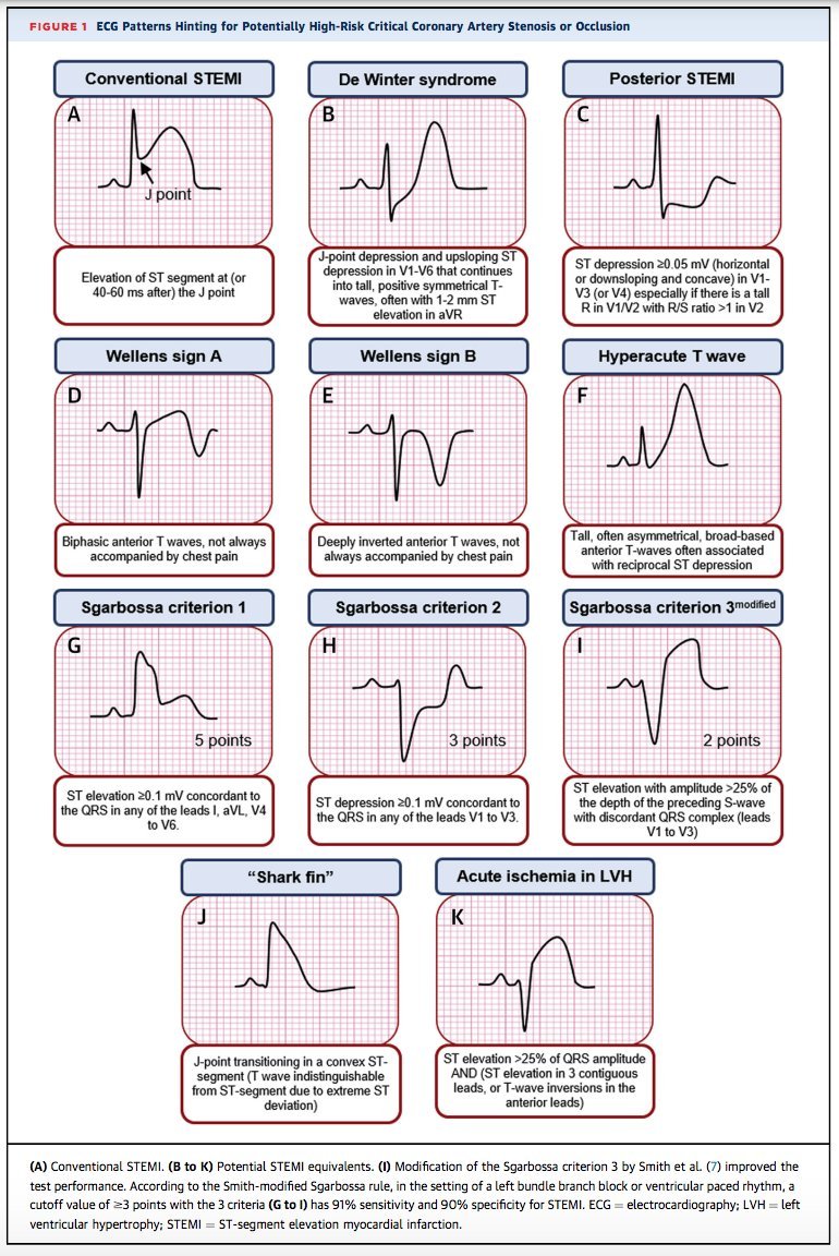 laura_rottner's tweet photo. 🤔Ist das jetzt ein STEMI oder nicht?🤔
Super Artikel für alle die in Zukunft im EKG nichts mehr übersehen wollen!
https://t.co/fWN4XGeVuv
@YoungDgk @AGIKinterv @AGEP_DGK @DjawidHashemi @sebFeickert @DennisLawin @Dominik_Linz @ChristianHeeger @Franzi_Koppe @FabianJBrunner https://t.co/Z1ekjTIVzb