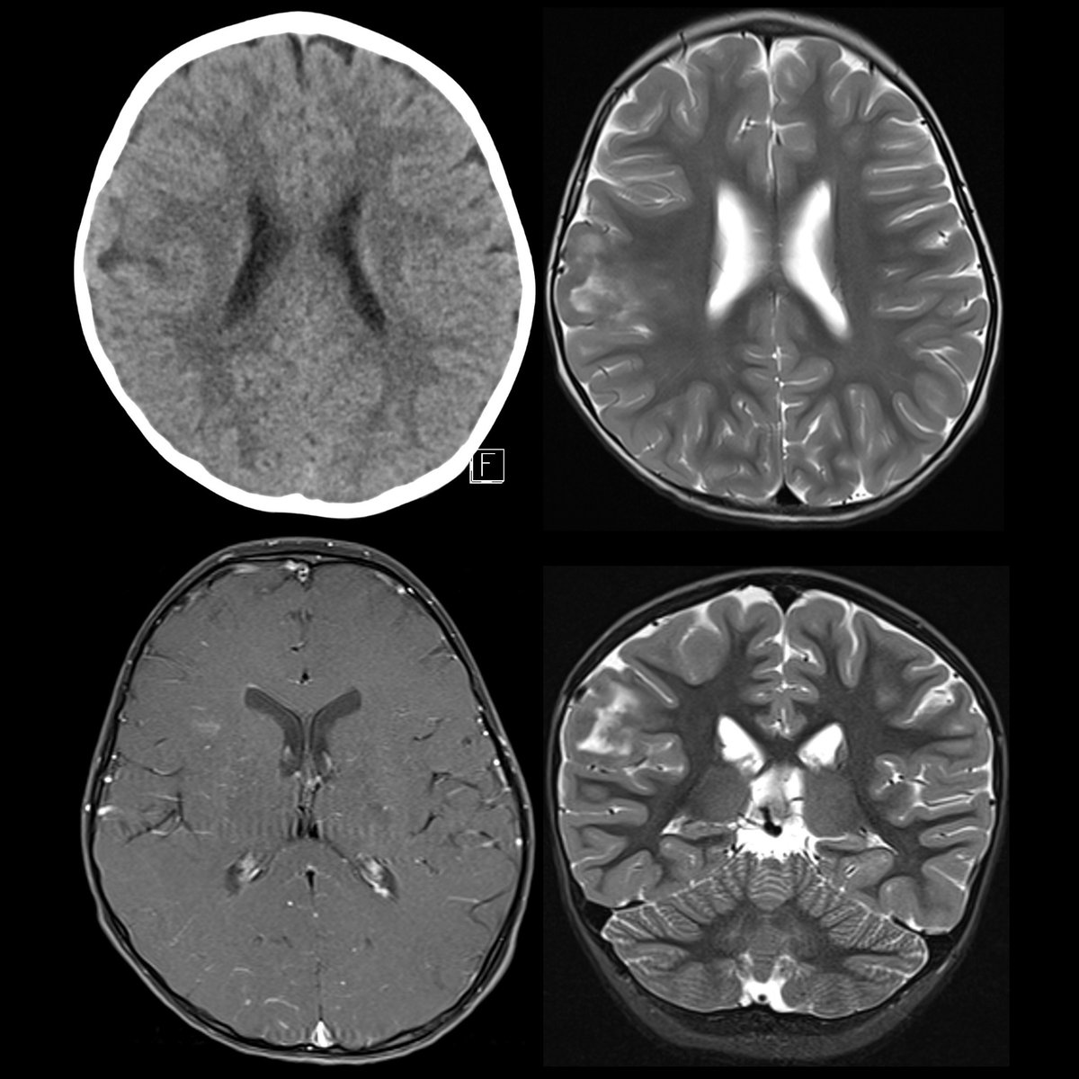 Preschooler with seizures

CT without contrast(above left) shows right parietal ill-defined subcortical hypodensity. 

#FOAMed #FOAMPed #FOAMRad #PedsRad #RadEd #RadRes #EmergencyMedicine #FOAMem #NeuroRad #PediNeuroRad #NeuroRadiology #Neurology #Neurosurgery