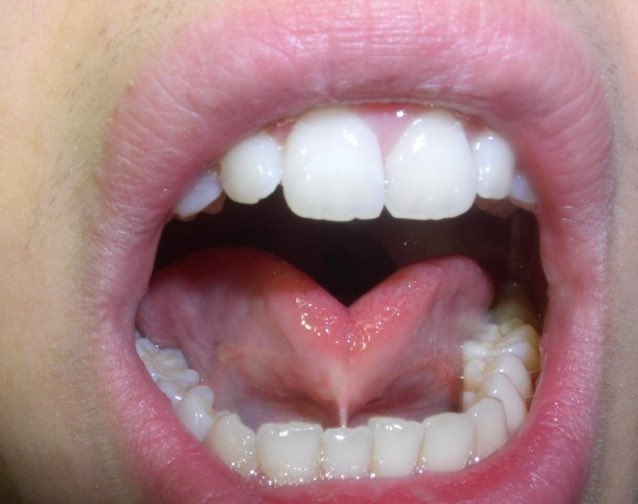 مساء الخير 
جمعة مباركة 🌹

قد سمعت عن * اللسان المربوط * ؟

بإذن الله راح نتلكم عنها غدًا ونتكلم عن علاجها وطريقة تشخصيها 😍