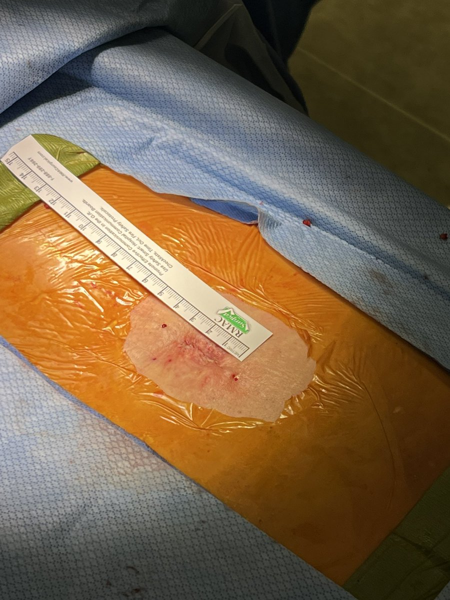 MichaelYangMD's tweet image. We just did 🇨🇦‘s first awake spine surgery @CalgarySpine in a patient too sick to undergo a GA. Couldn’t have done it without a great team @AHS_media @UCalgaryMed.

Come hear about it at the Canadian Spine @spinecanada Meeting in Quebec City in March.

Posted w/ permission.