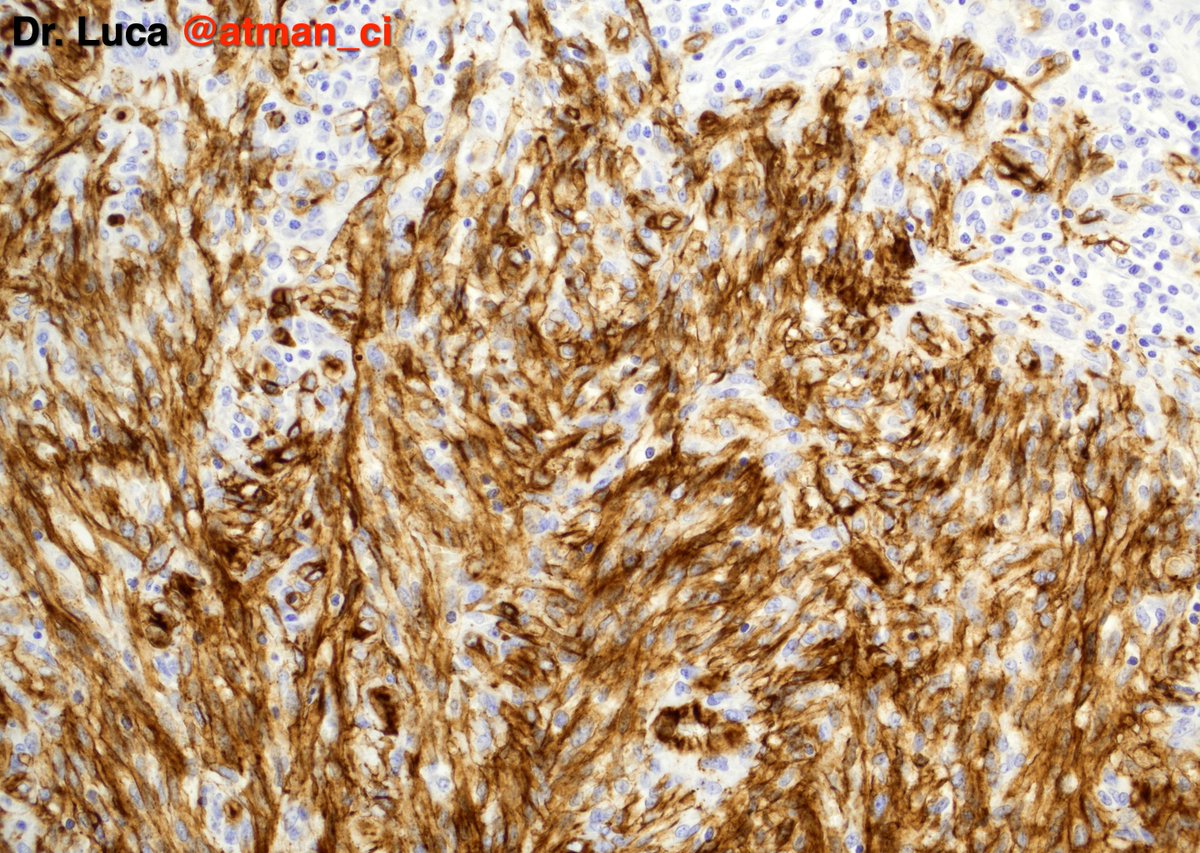 A special #BSTPath hat trick, same IHC but different diagnoses, N°1: old F, trunk dermal lesion, your thoughts? <a href="/PoloniaAntonio/">A. Polónia</a> <a href="/SumantaDas_7/">Sumanta Das</a> <a href="/sumeyra_md/">Sumeyra Kartal</a> <a href="/NeoCrazee/">SANO Naoki, MD, Pathologist, Japan</a> <a href="/rehdam/">Rehdam (Madiha)</a> <a href="/DrGeeONE/">Olaleke Folaranmi</a> <a href="/seyma_buyucek/">Şeyma Büyücek</a> <a href="/LepinePathol/">Charles Lépine, MD</a> <a href="/LuizMiguelN/">Luiz M. Nova-Camacho, MD</a> <a href="/DrNishatAfroz2/">Nishat Afroz MD</a> <a href="/Greg_Charville/">Greg Charville</a> <a href="/DrBMcGinn/">Barry McGinn</a> #PathTwitter