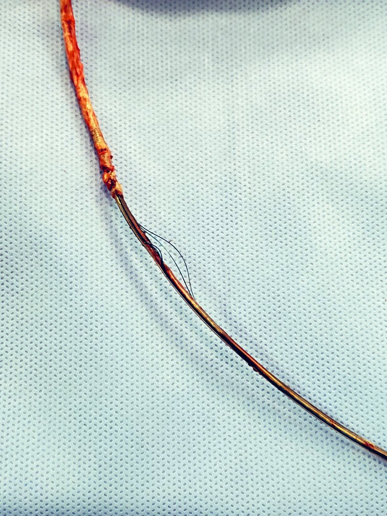 They (Riata leads w/ externailzed cables) are still out there… Luckily this one (over 12 years old) didn’t put up too much of a fight coming out. #EPeeps