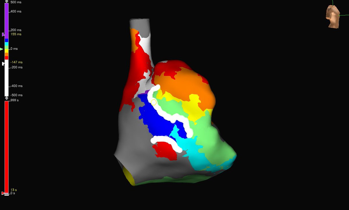 subparsonsmaps's tweet image. Friday flutter with this beauty of an RA circuit. #HDgrid was used to map this circuit and termination occurred within 1 sec of RF. #mapmoreburnless @AbbottCardio