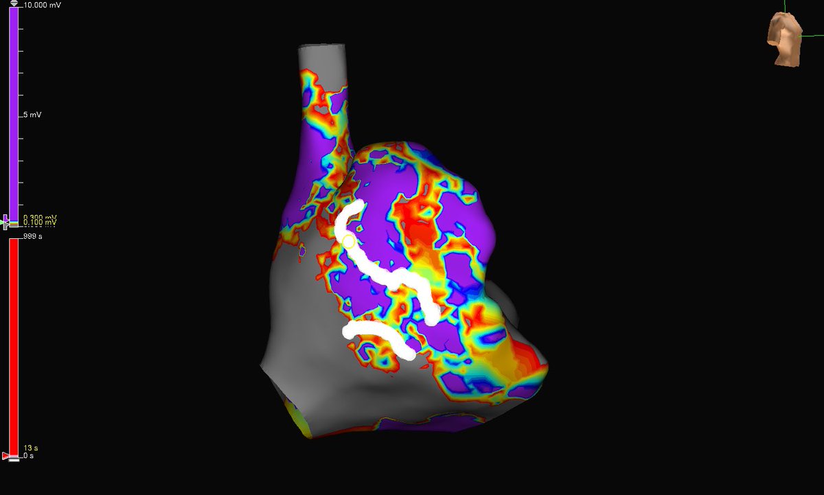 subparsonsmaps's tweet image. Friday flutter with this beauty of an RA circuit. #HDgrid was used to map this circuit and termination occurred within 1 sec of RF. #mapmoreburnless @AbbottCardio