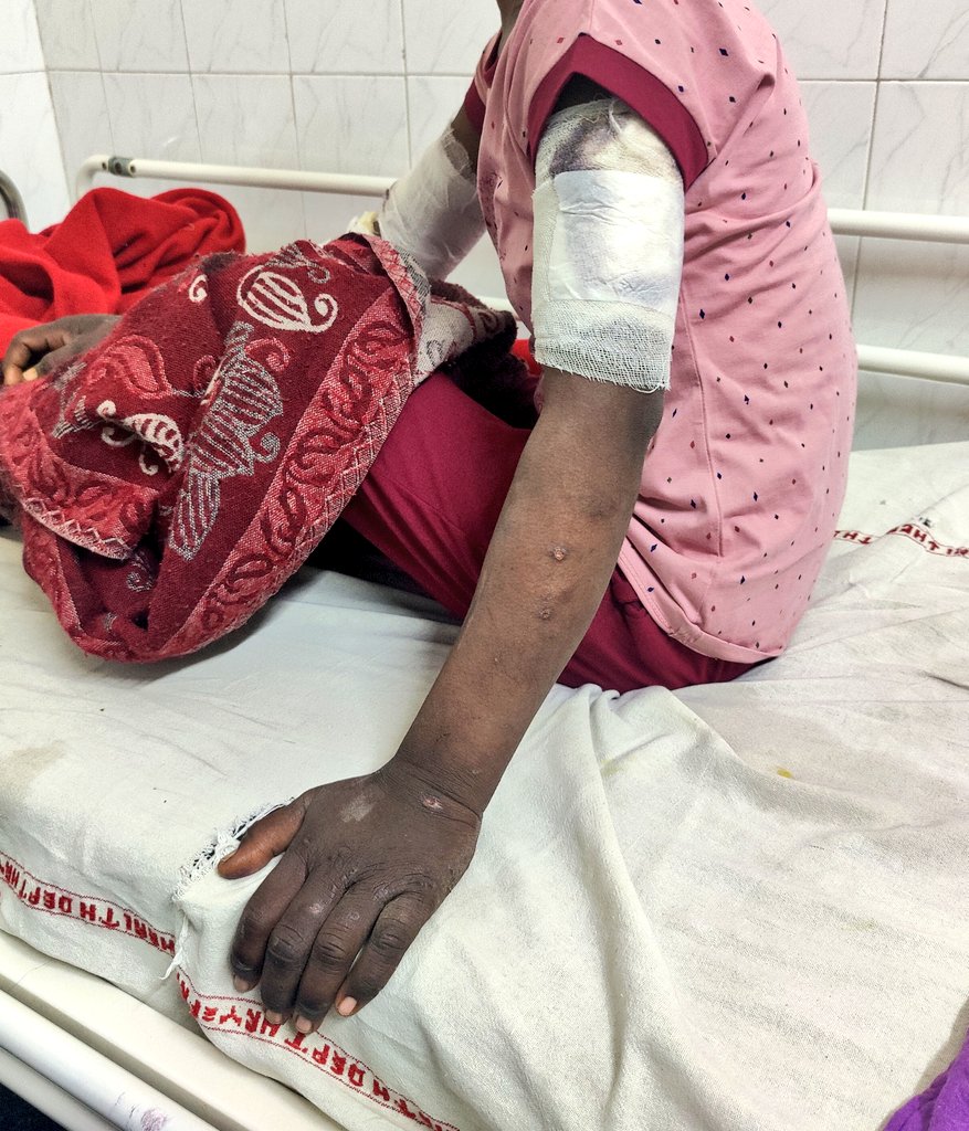 DeepikaBhardwaj's tweet photo. Kamaljeet &amp; Manish broke 3 WIPERS &amp; many STICKS in last 4 months in beating this child. They kept a watch from office via CCTV &amp; if she ate anything, she was beaten. Kamaljeet broke child's teeth hitting her with kadchi

Belts, fork, Kadchi, chimta, belan, Tawa - THEY USED ALL https://t.co/G4aYzYWxmq