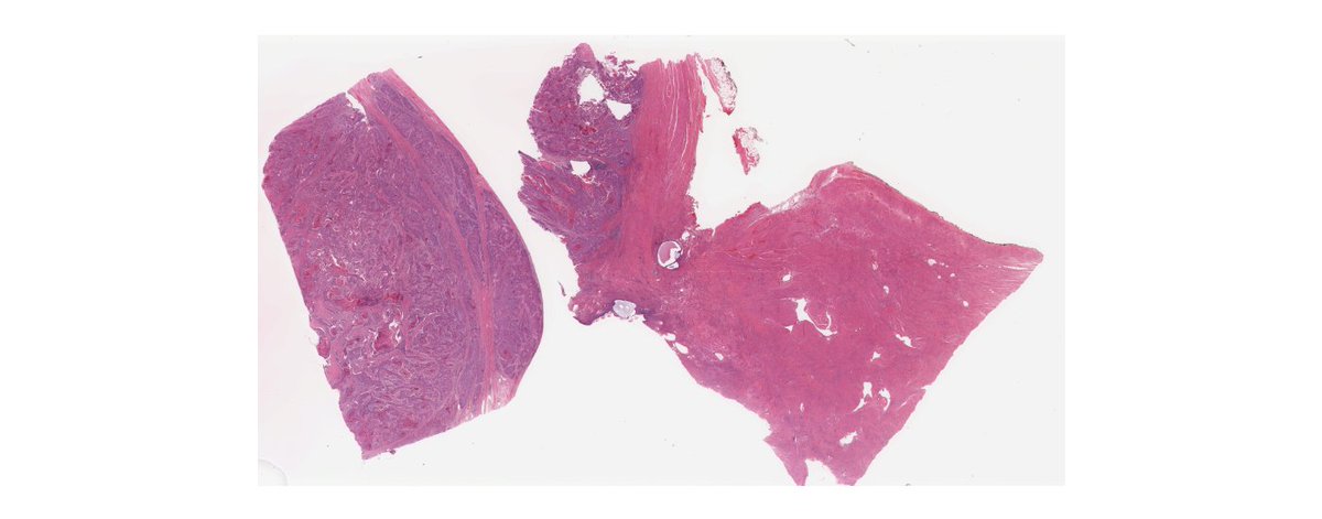 Ensuring best #PatientOutcomes of those with #BloodCancer depends on rapid biopsy assessment by specialised #pathologists a rapidly declining pool of individuals.

 Message us to find out how we are reducing this burden with #ArtificialIntelligence.
  
#Pathology #StartupInvestor