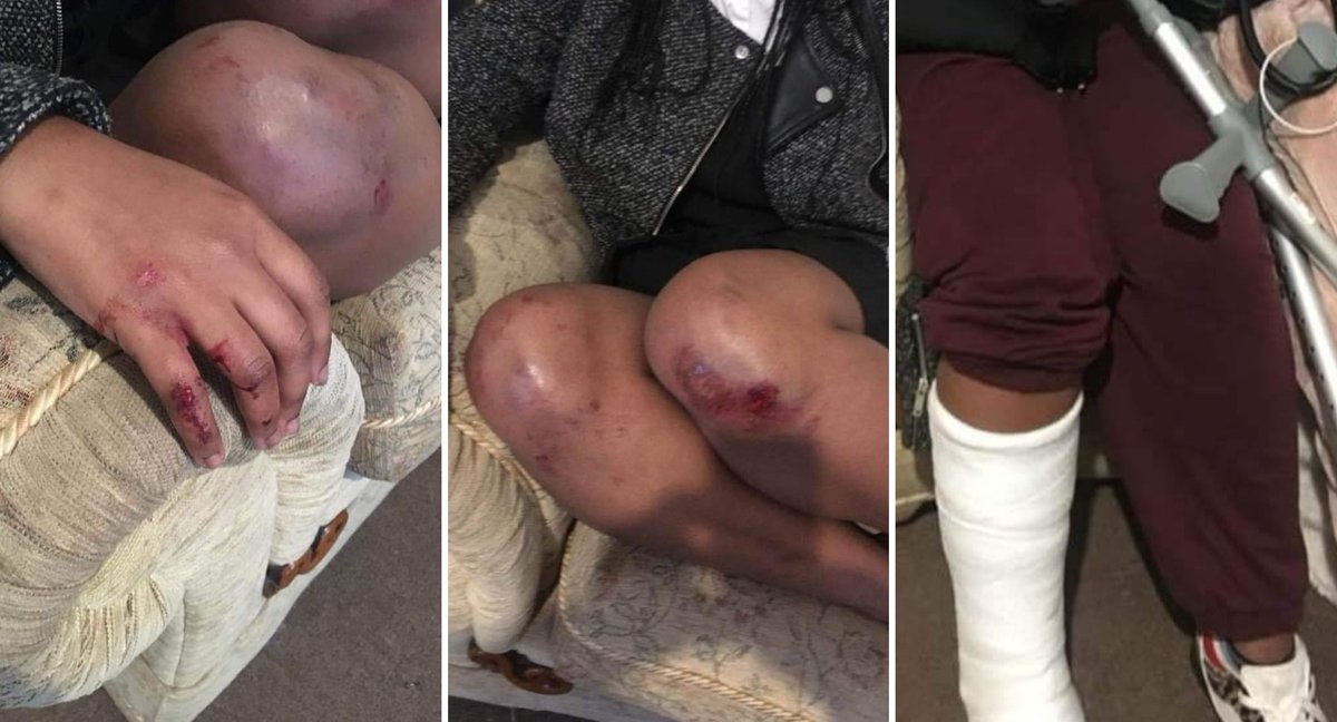 PHOTOS: The Black schoolgirl who was attacked at <a href="/ThomasKnyvett/">Thomas Knyvett</a> College sustained severe injuries, including bruises &amp; cuts on her body &amp; lost some of her hair. She is now relying on crutches to move around because of a leg injury. Only photos not revealing her identity are shown