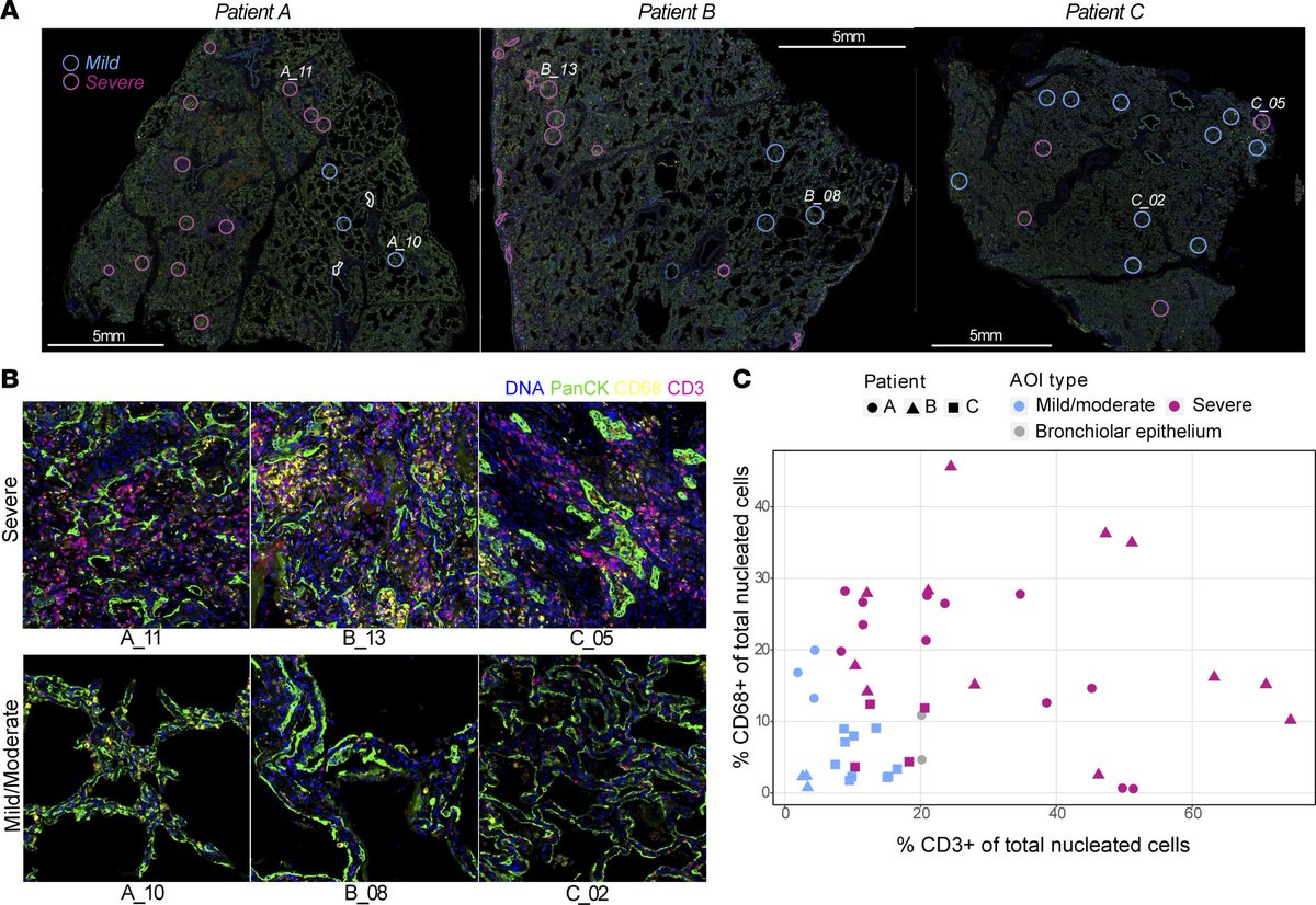 Bruker Spatial Biology (@brukerspatial) on Twitter photo .<a href="/fgissa/">Fadi Issa</a>’s team from <a href="/NDSurgicalSci/">Nuffield Department of Surgical Sciences</a> used #GeoMx on lung samples from severe #COVID19 patients to evaluate protein and RNA distribution.
This multi-omic dissection identified cell types and pathways at the origin of the alveolar injury. #FridayRead
bit.ly/3IeQxkY .<a href="/fgissa/">Fadi Issa</a>’s team from <a href="/NDSurgicalSci/">Nuffield Department of Surgical Sciences</a> used #GeoMx on lung samples from severe #COVID19 patients to evaluate protein and RNA distribution.
This multi-omic dissection identified cell types and pathways at the origin of the alveolar injury. #FridayRead
bit.ly/3IeQxkY