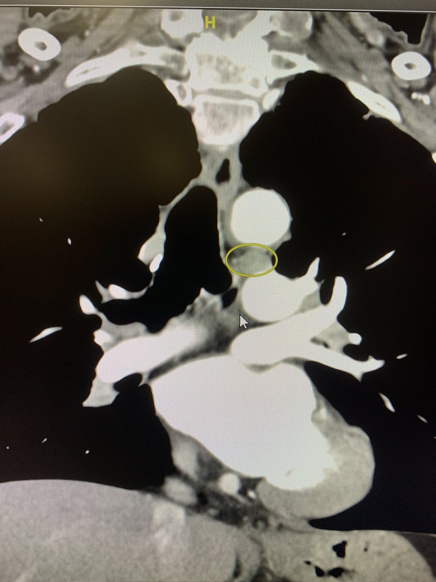 santihergoneumo's tweet photo. Correlación TC-EBUS, adenopatía 4L entre Ao y AP.
#neumologiaintervencionista https://t.co/tpQ4VMhFu6