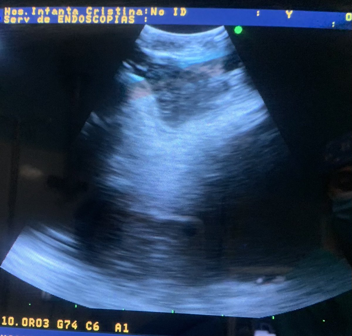 santihergoneumo's tweet photo. Correlación TC-EBUS, adenopatía 4L entre Ao y AP.
#neumologiaintervencionista https://t.co/tpQ4VMhFu6