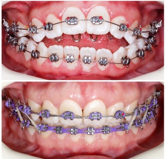 Afyayakinywa's tweet image. #Orthocase 
#Openbite