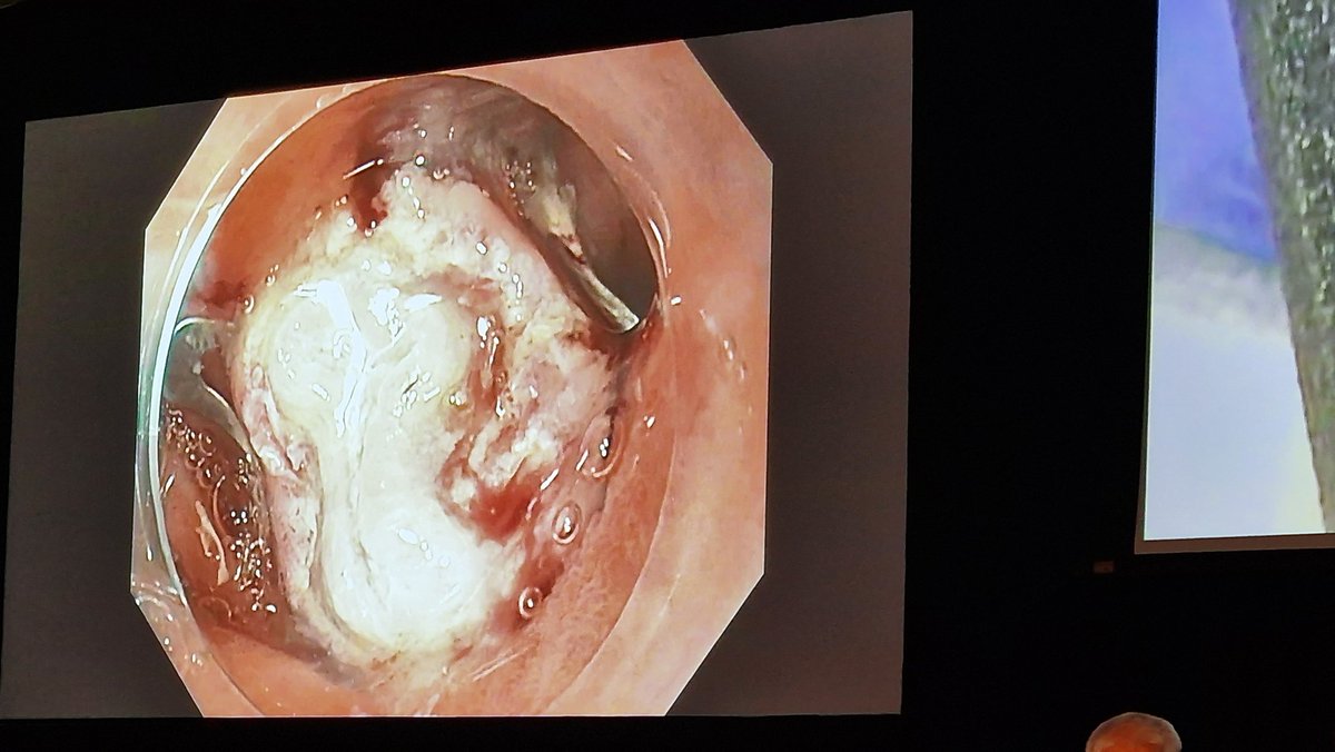 SyedGerdezi's tweet photo. Mastero @KKadkhodayan in action, with skilful full-thickness resection of #GIST from D1 with #OVESCO pre-treatment.
#OLE2023 https://t.co/ZFgwk2rjRk