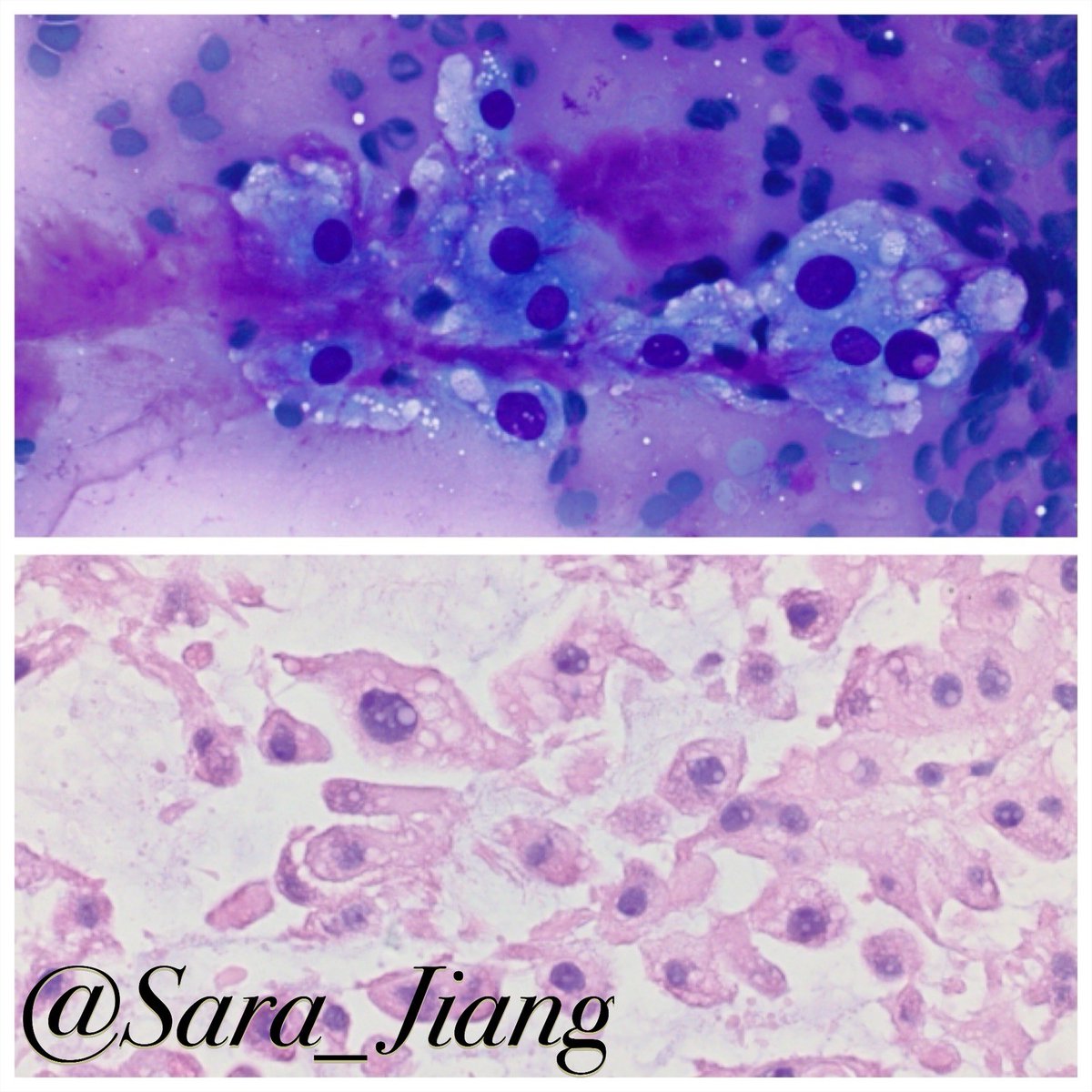 Sara_Jiang's tweet photo. Today’s #FNAFriday #CytoHisto correlation
🫧Physaliferous (bubbly) cells in myxoid stroma: a classic case of chordoma
(Top:DQ Below:H&E)
🟤(+) Brachyury
👉🏼#PathPitfall: when presenting as head/neck mass, stroma can lead to impression of pleomorphic adenoma https://t.co/QWikpQg17s