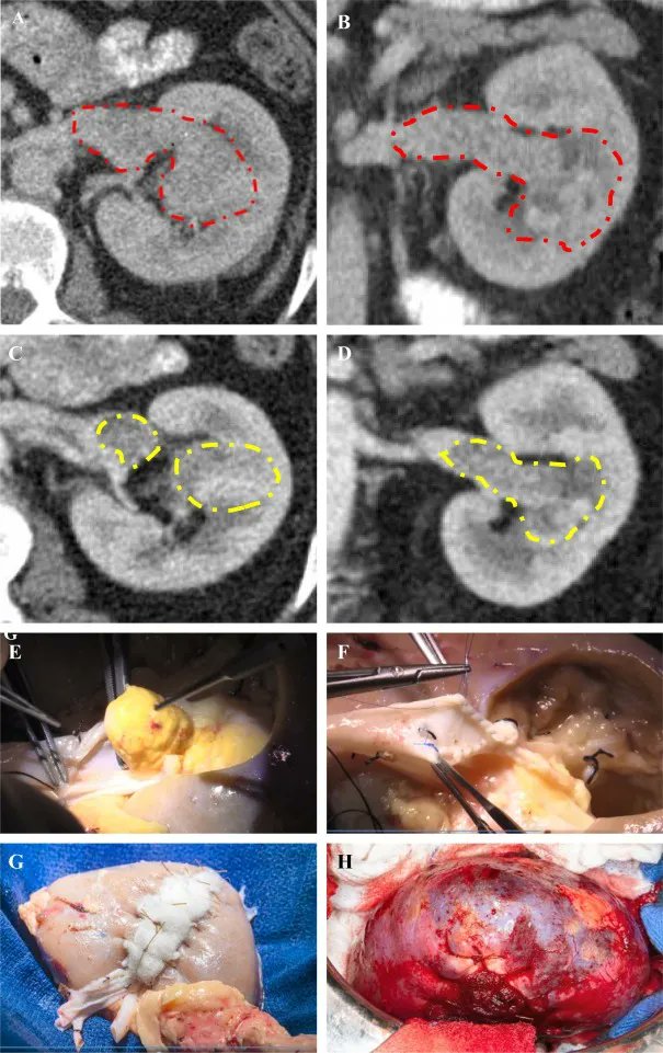 EurUrolOncol's tweet photo. Current Issue: Comprehensive Management of Renal Masses in Solitary Kidneys 

https://t.co/kBP63vb86u 

@LWegp @RathiNityam @LamontWilkinsMD @GustavoRoversi4 @AoZhangUro @DAP_urology @martin_hofmann_ @drjkaouk @rabouassalymd @cjweight 

#kidney #UroOnco #MedTwitter https://t.co/ACPt07WBEV