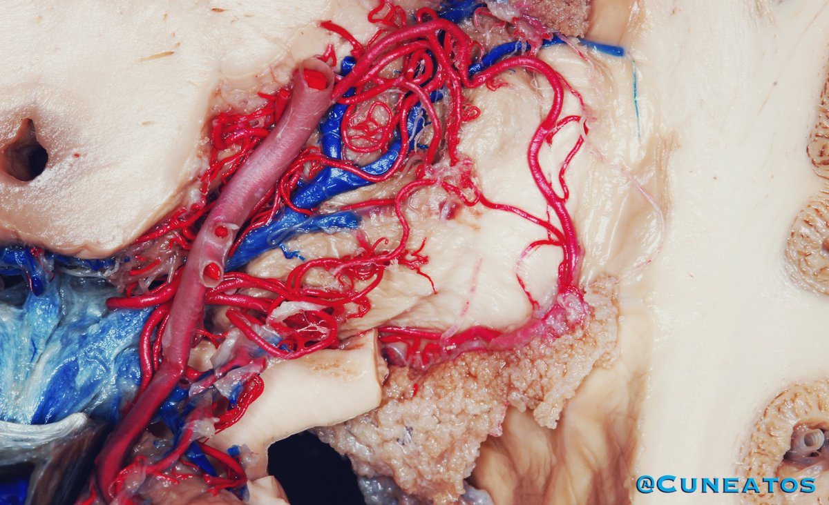 Cuneatos's tweet photo. “El sistema vascular no tiene palabra de honor.” En relación a la variabilidad anatómica del sistema vascular cerebral. Segmento P2-P3 de la ACP, arterias coroideas posteriores, Glomus de los plexos coroides, vena basal de Rosenthal drenando a la vena cerebral magna de Galeno. https://t.co/jZ7rpYPRlw