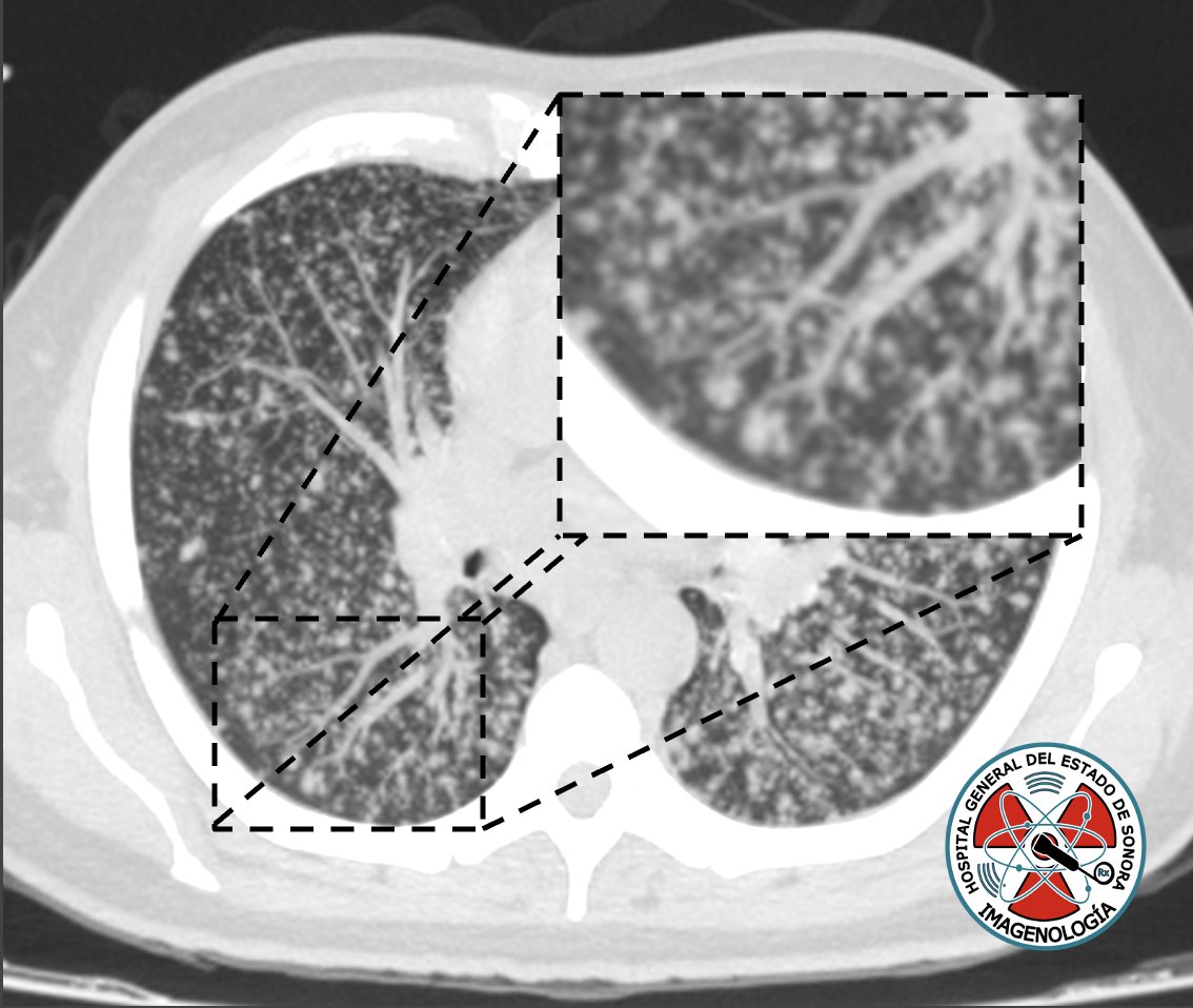 ¿Cuál es el nombre del signo? 🌳

#radiology #radres #CT #FOAMed #foamrad <a href="/claudiarx18/">Claudia V.</a>