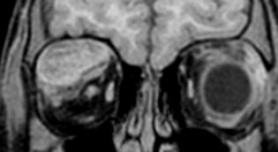 Tip of the day 💡: In children with sickle cell disease, a cardinal differential for this subacute proptosis is spontaneous hemorrhage. This is a very important point to remember! Think laterally this weekend folks.