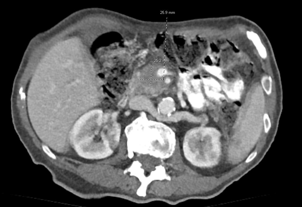 David Diehl (@daviddiehlmd) on Twitter photo I love eponyms! Here is one of my favorites: Courvoisier's gallbladder (or sign). Painless palpable GB, from biliary obstruction usually due to panc CA. Weight loss, as in this case, makes it easier to palpate. <a href="/DouglasAdlerMD/">Douglas G. Adler MD, FASGE, FACG, AGAF</a> #GITwitter <a href="/ASGEendoscopy/">ASGE GI Endoscopy</a> @RuchitShahDO <a href="/drkeithsiau/">Keith Siau</a> I love eponyms! Here is one of my favorites: Courvoisier's gallbladder (or sign). Painless palpable GB, from biliary obstruction usually due to panc CA. Weight loss, as in this case, makes it easier to palpate. <a href="/DouglasAdlerMD/">Douglas G. Adler MD, FASGE, FACG, AGAF</a> #GITwitter <a href="/ASGEendoscopy/">ASGE GI Endoscopy</a> @RuchitShahDO <a href="/drkeithsiau/">Keith Siau</a>