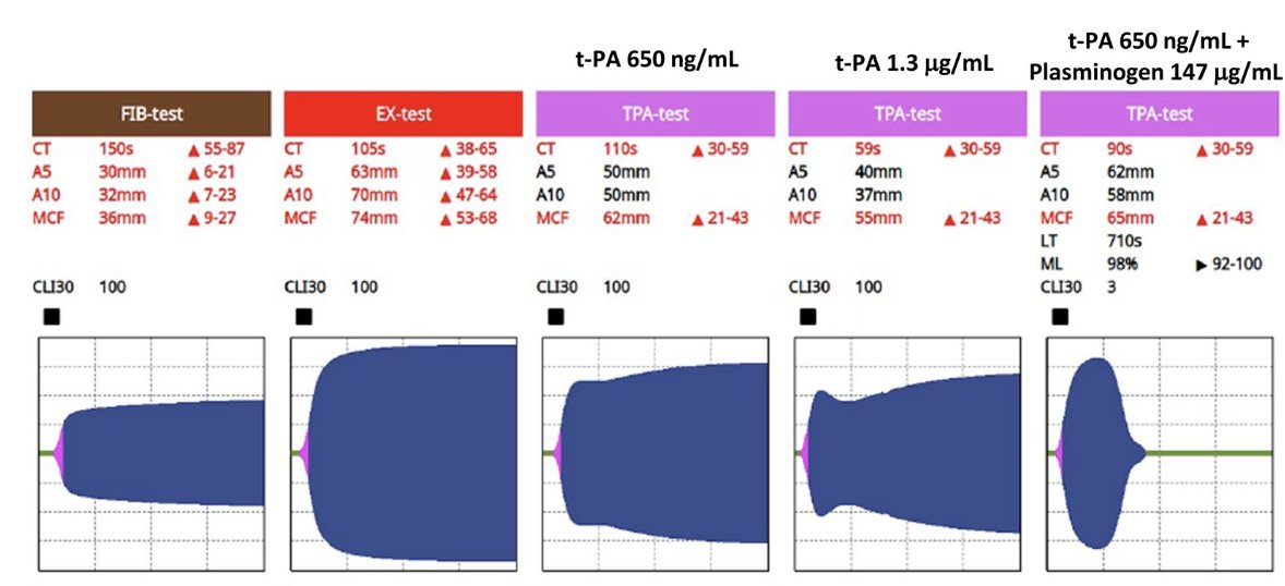 haemoview's tweet photo. Amazing work here in Australia showing how #ClotPro may be utilized to investigate the potential mechanisms of #fibrinolysis resistance, guide corrective treatment, and monitor in real-time the treatment #tpa #plasminogen https://t.co/VLlNAAiSO2 https://t.co/rn689SzwIJ