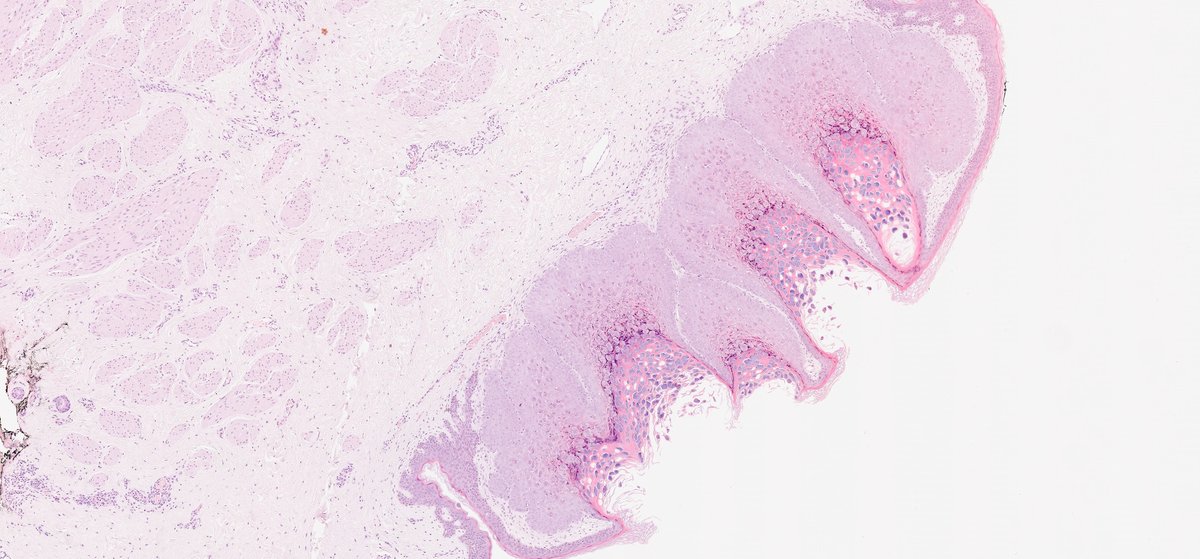 slusagar's tweet image. numerous #pathtweets images avail for molluscum contagiosum...
however, adding this🔬 from breast skin bx😲

#IDpath #dermpath