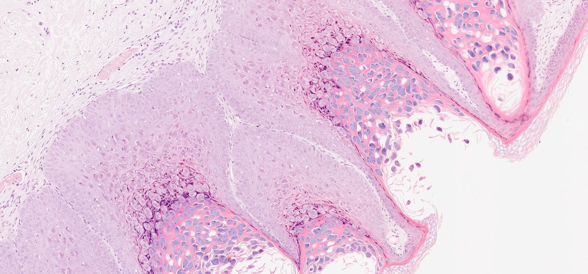 slusagar's tweet image. numerous #pathtweets images avail for molluscum contagiosum...
however, adding this🔬 from breast skin bx😲

#IDpath #dermpath