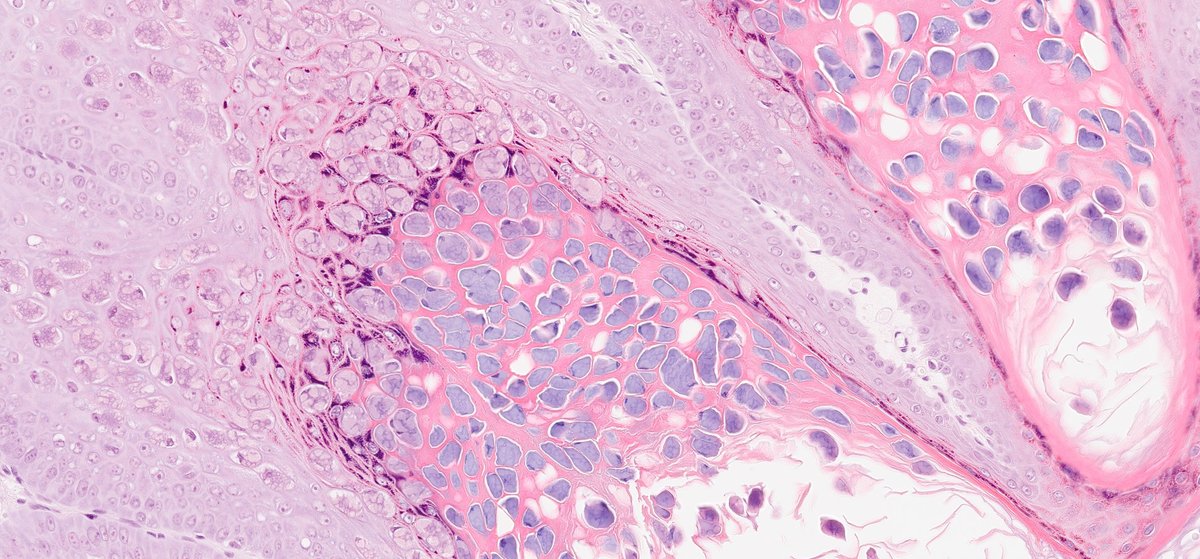 slusagar's tweet image. numerous #pathtweets images avail for molluscum contagiosum...
however, adding this🔬 from breast skin bx😲

#IDpath #dermpath