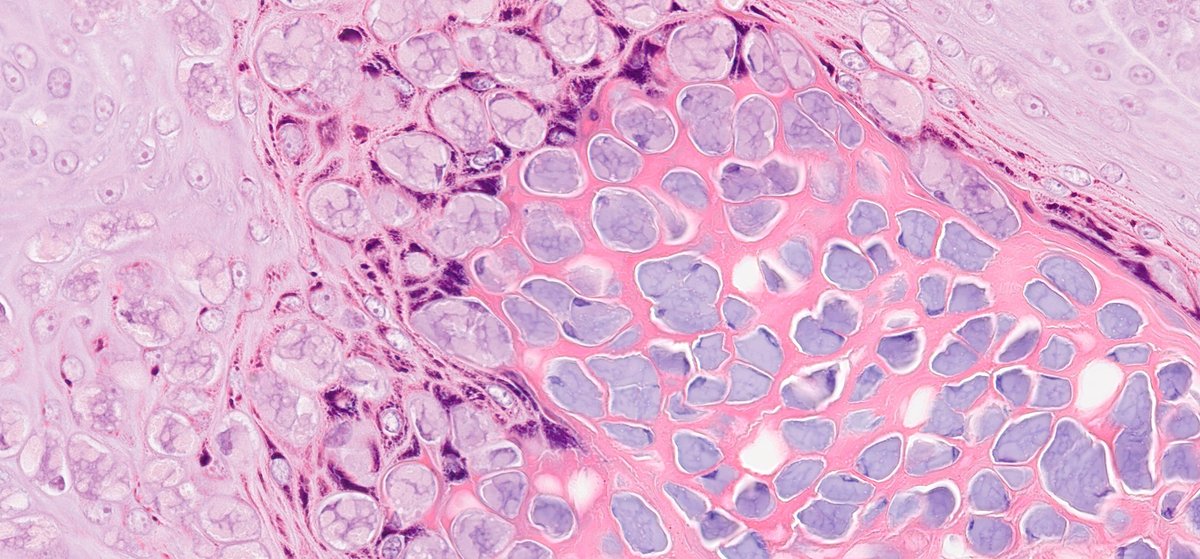 slusagar's tweet image. numerous #pathtweets images avail for molluscum contagiosum...
however, adding this🔬 from breast skin bx😲

#IDpath #dermpath