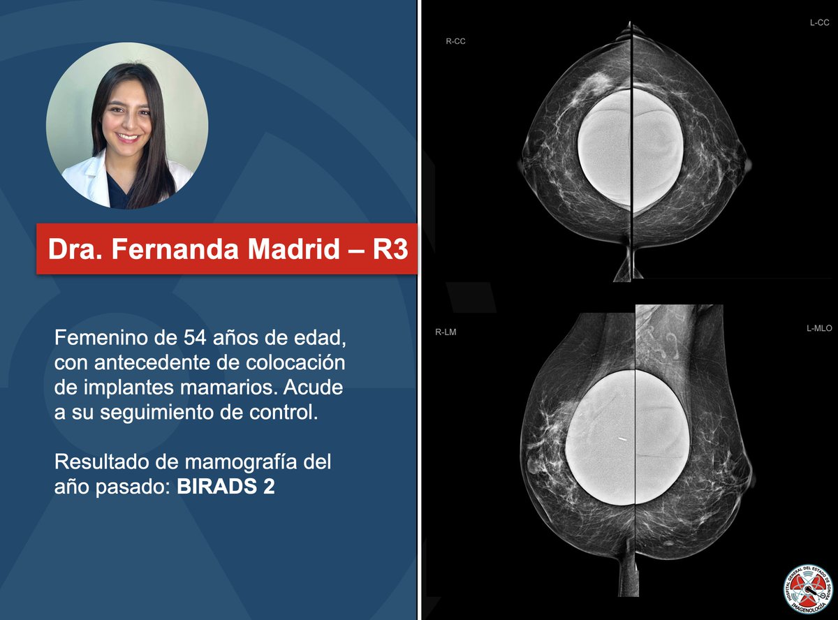 Se presentan imágenes de mamografía digital con proyecciones craneocaudal y medio lateral oblicua de ambos senos en nuestro caso semanal. ¿Cuál es tu diagnóstico?  #breastradiology #breastimplants #radiology #mammography <a href="/XochitlMadrid1/">Fernanda Madrid</a>