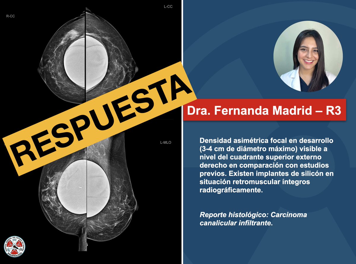A continuación la respuesta del caso semanal. ¡Excelente viernes! #breastradiology #breastimplants #radiology #mammography <a href="/XochitlMadrid1/">Fernanda Madrid</a>