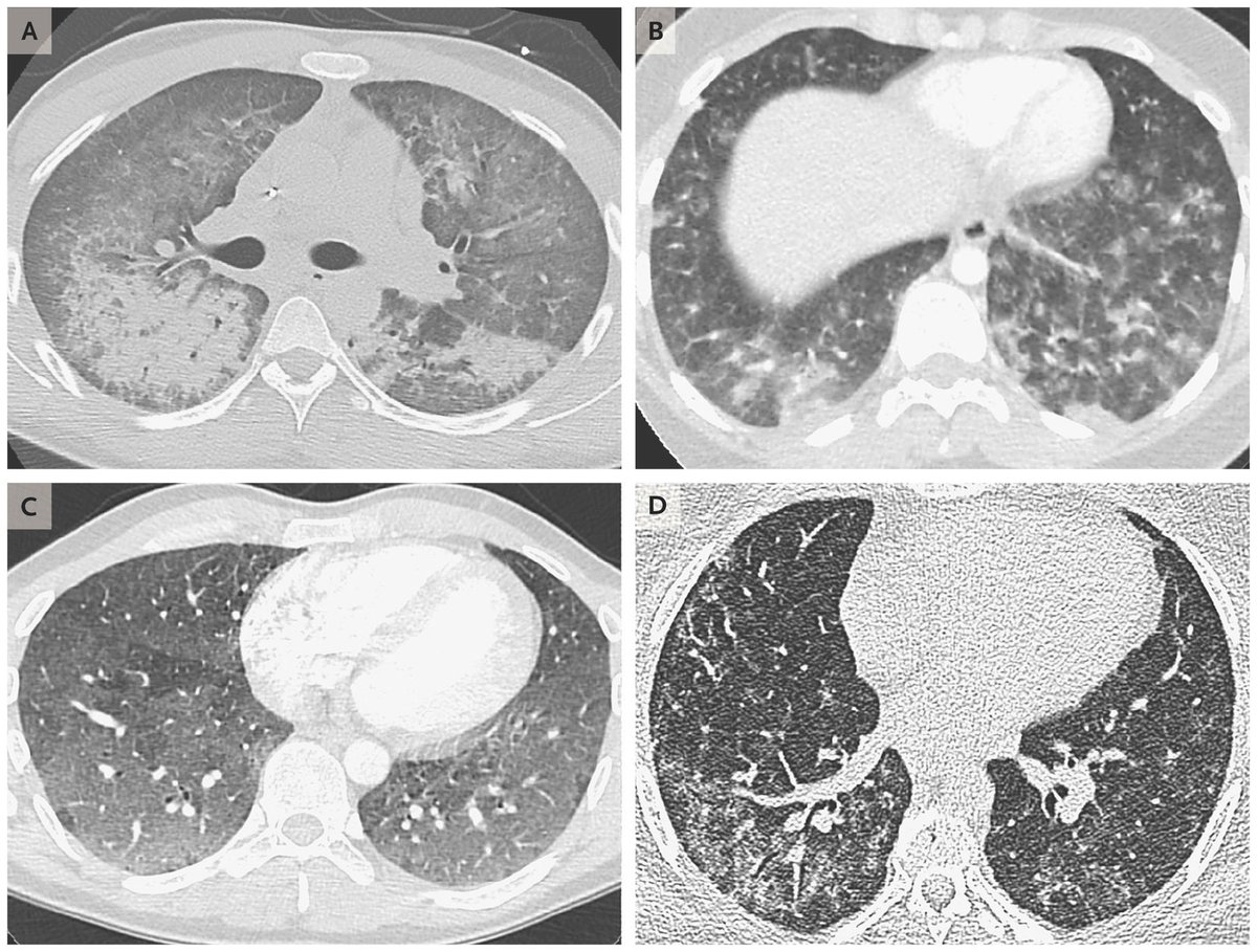 DavidForeroMD's tweet photo. Los disolventes que se usan para calentar y aerosolizar los aromatizantes, consisten en diversos #aldehídos y #alcoholes, son lesivos para el pulmón. Las lesiones más frecuentes son consolidaciones y opacidad en vidrio deslustrado, a menudo con áreas lobulillares o subpleurales. https://t.co/8iH1agB5AU