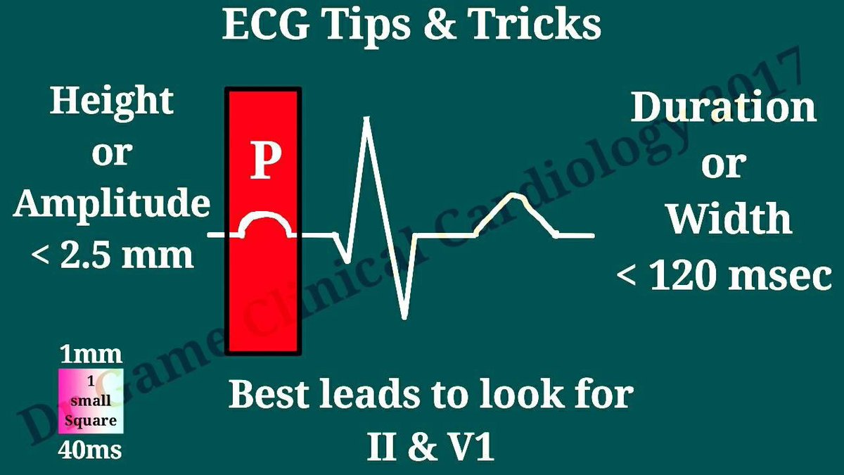 P waves on #ECG #ClinicalMedicine #MedicalEducation #study #Exams #medicalstudent #medicalExams #Pwaves #ClinicalPearl