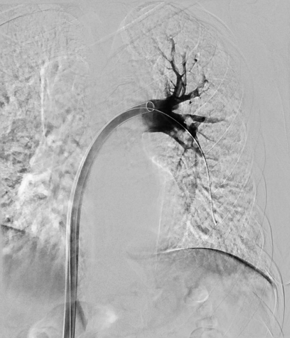 andruelee's tweet photo. Another satisfying @InariMedical PE. Forgot to snag a pic of the right PA. #inari https://t.co/9ea2h3qnYK