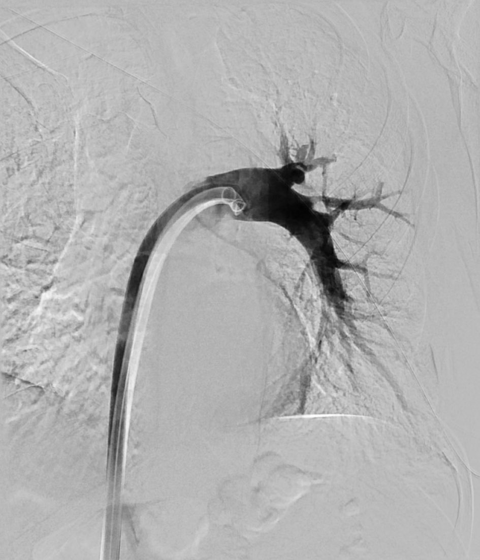 andruelee's tweet photo. Another satisfying @InariMedical PE. Forgot to snag a pic of the right PA. #inari https://t.co/9ea2h3qnYK