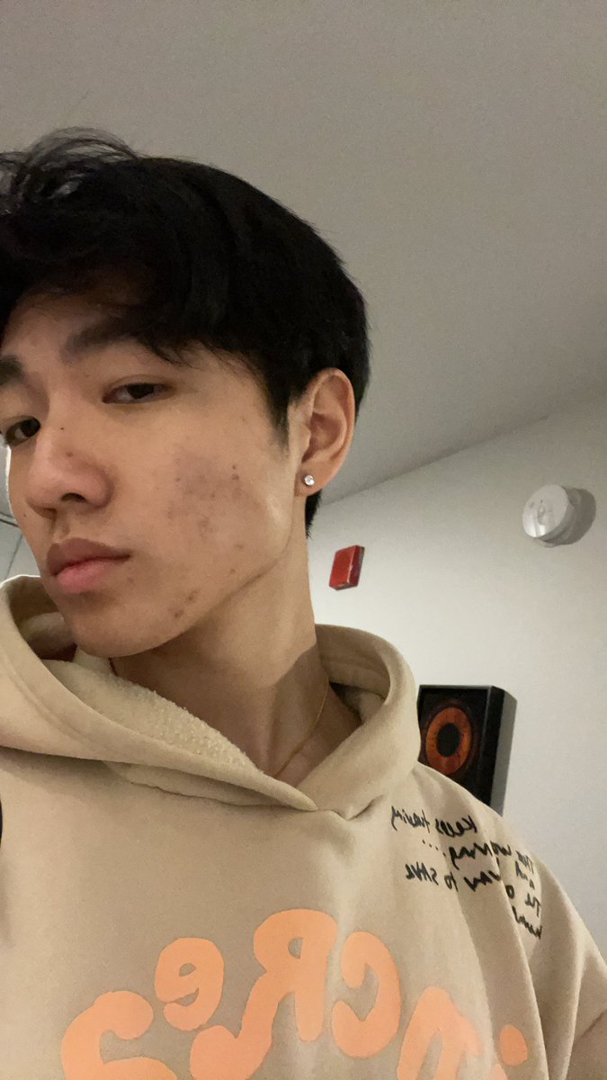 Acillac1's tweet photo. pierced 😃 https://t.co/W7MMVyJ2nx