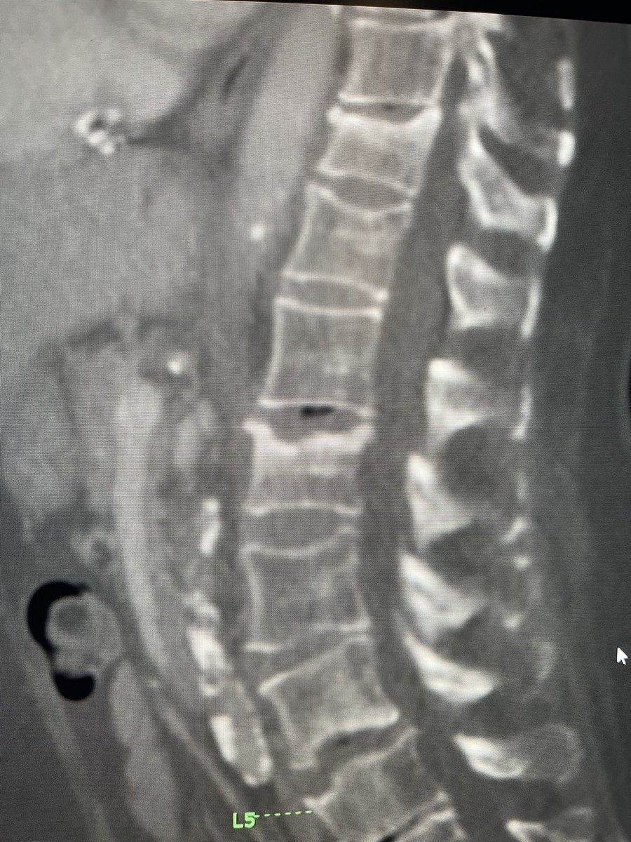 darthglader's tweet photo. More #MSKIR in a woman with compression fractures after a fall. She thought it was due to a urinary tract infection.
CT shows compression fractures.
#EpiduralBlock before the case. https://t.co/MiLJt4pAgt