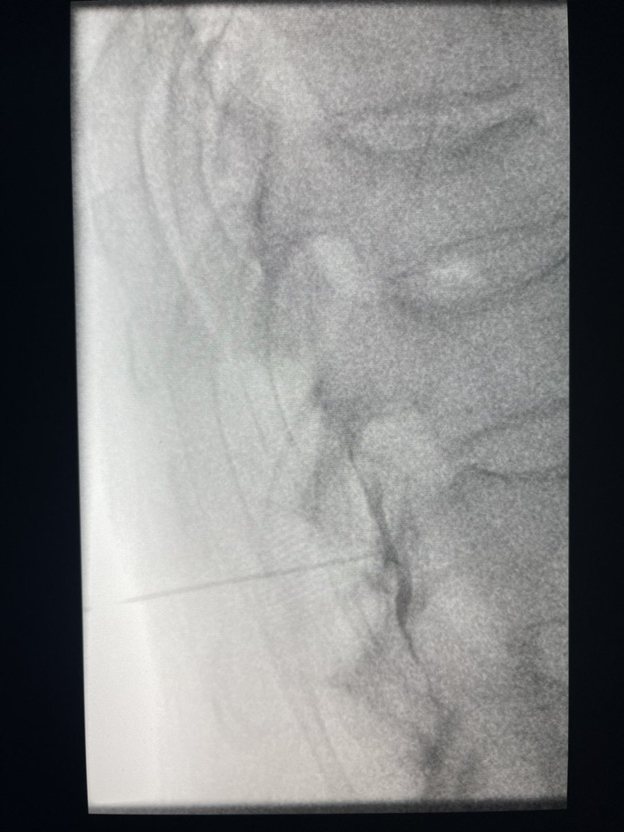 darthglader's tweet photo. More #MSKIR in a woman with compression fractures after a fall. She thought it was due to a urinary tract infection.
CT shows compression fractures.
#EpiduralBlock before the case. https://t.co/MiLJt4pAgt