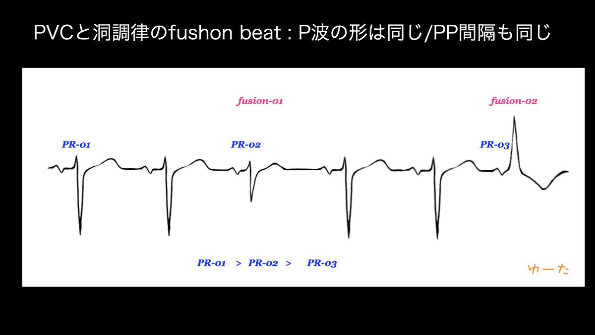 NaokiThukishima's tweet photo. #YellowPVC-03
本当にP,P'はPVCでは先行しないの🧐
2/9の(みんなでPVCをやっつけろ!!２@徳田道史先生)でもありましたけど、fusion beatで有り得ます。
先行するP波が心室に侵入すると同時にPVCが発生して、心室内で興奮が混じり合う状態です。
よく見るとPR間隔が、PR-01>PR-02>PR03ですね。 https://t.co/iCPs3798TQ