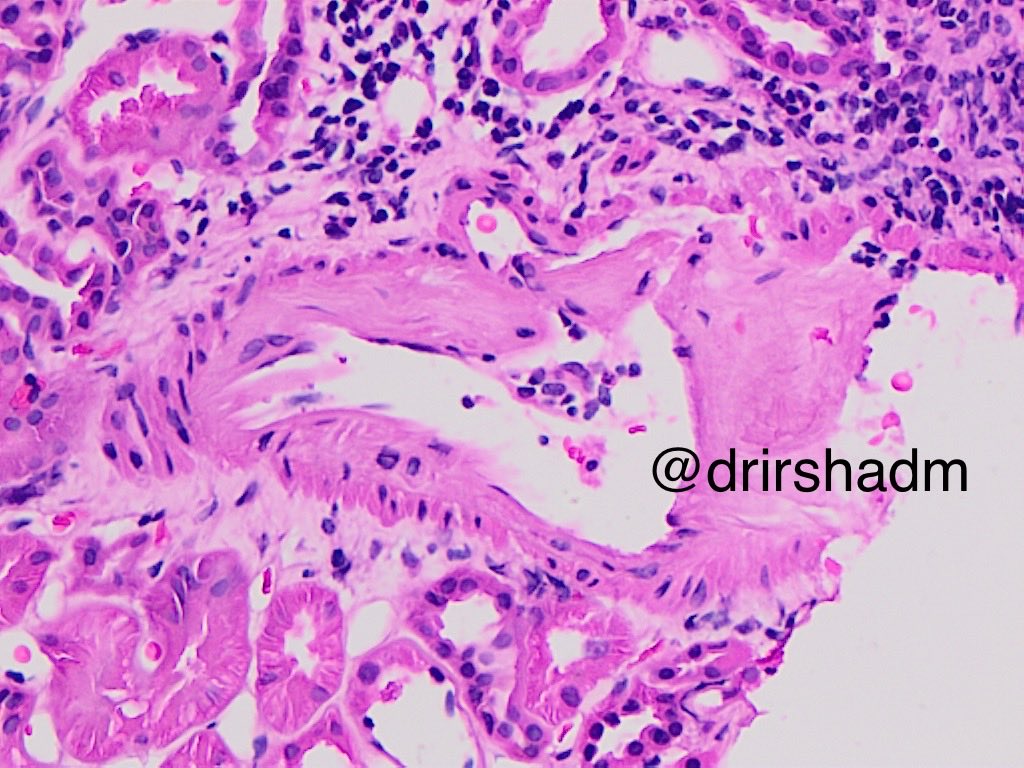 drirshadm's tweet image. Intimal arteritis/ endarteritis post Tx day 10 , creatinine of 3 , a case of mixed TCMR &amp;amp; ABMR #renalpath #kidneypath  #transplantpathology
