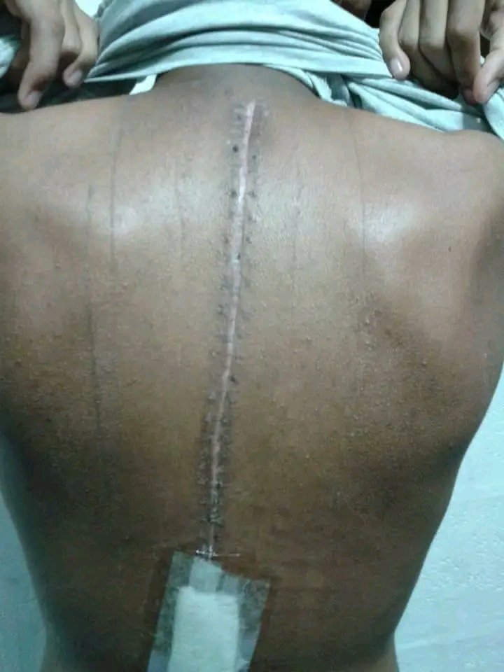 NeRioMacDuana's tweet photo. @DBE_SA @AngieMotshekga #departmentofeducation stop this nonsense of expecting our grade 4 kids to carry these heavy bags as if they are in High skul. You are killing our kids backs. This surgery cost R3m. So sad that our kids are becoming scraps by each day https://t.co/MitrALT3jJ