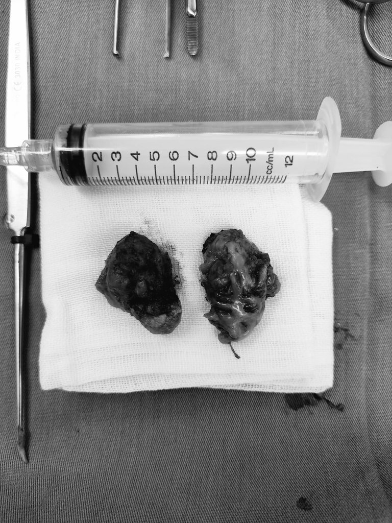 Fiqih22's tweet photo. Malah mirip sate kerang 
*Content warning*
Tonsilectomy. 
Operasi pengangkatan tonsil atau biasa disebut org awam radang amandel https://t.co/zxwD2buyU8