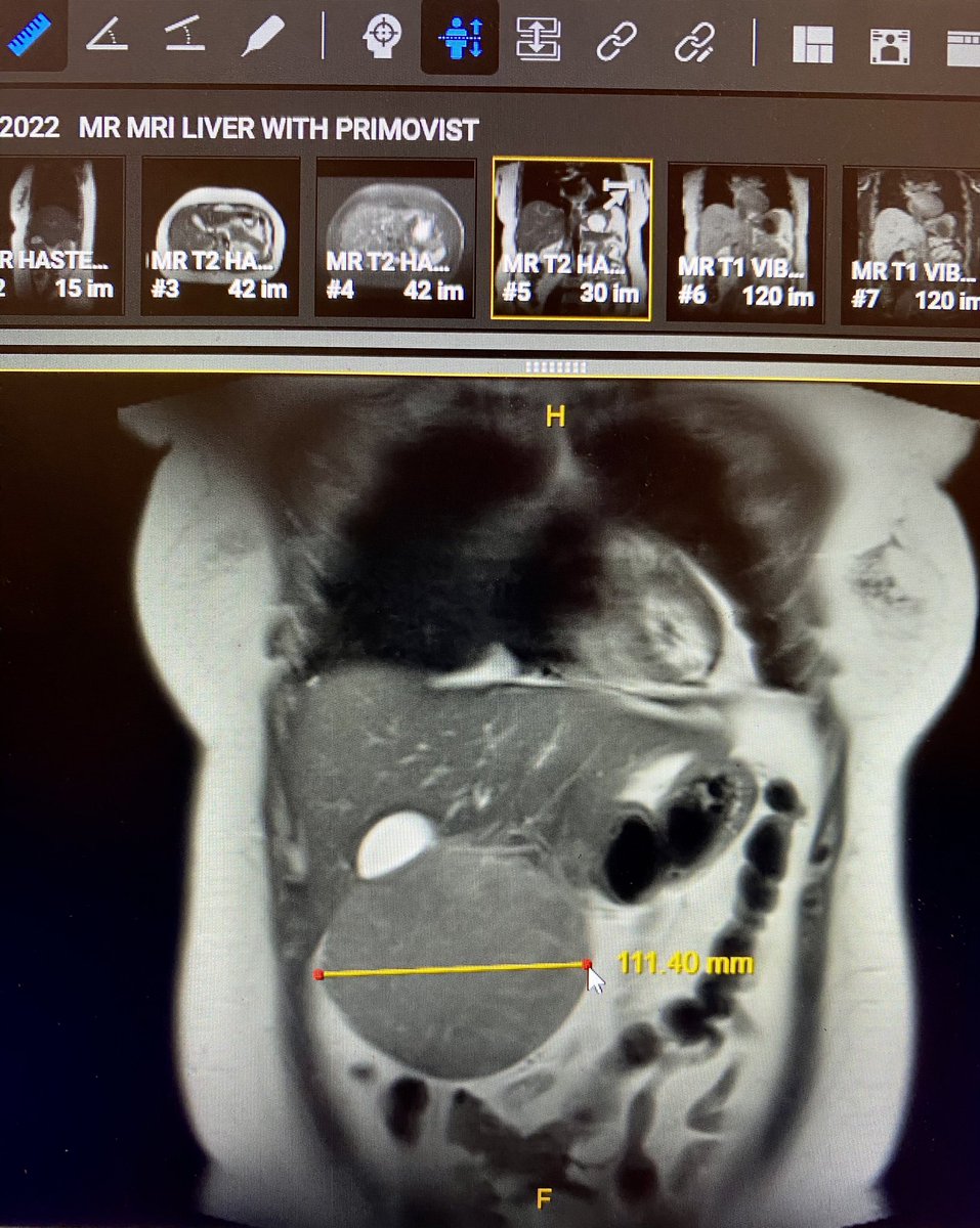 Chris_SHLim's tweet photo. Hi #hpb folks, what do you reckon this is?? MRI Primovist says FNH. https://t.co/mTnJT3sCKP
