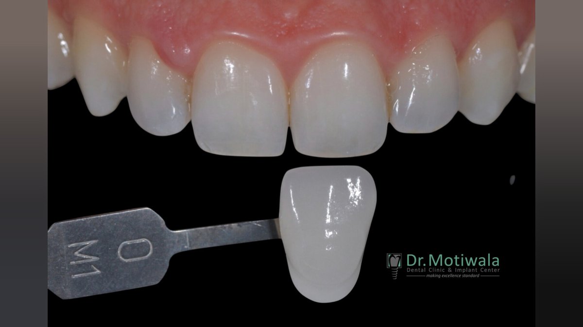 drmotiwaladcic's tweet photo. The VITA Easy shade digital spectrophotometer was developed for precise, fast and reliable shade determination of natural teeth and #ceramic restorations. #Toothcolor is a very personal choice, by following a Shade Guide of #Teeth, you can create a look that is perfect for you. https://t.co/vbWq0L92yg