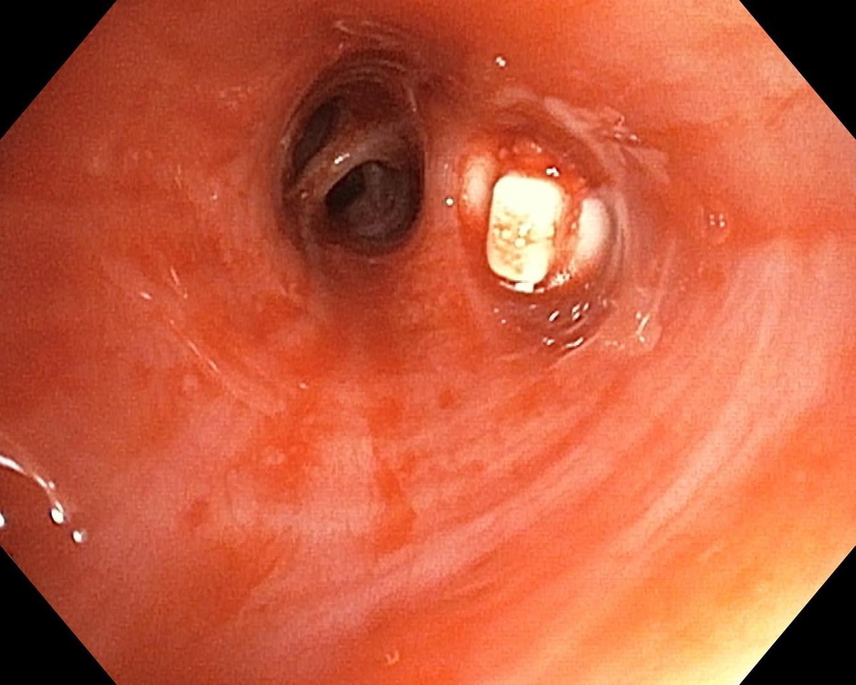 Pulmonary Endoscopy tweet media