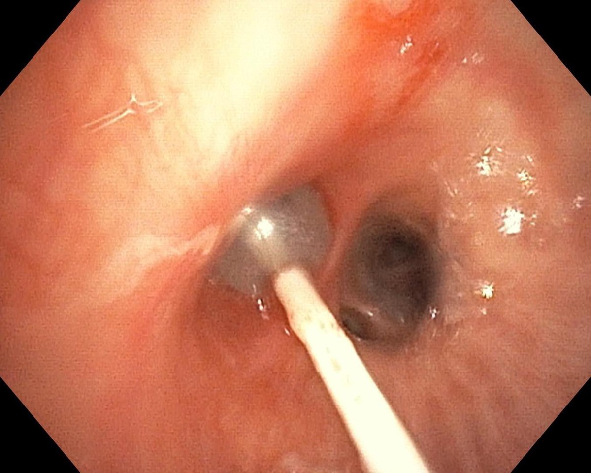 Pulmonary Endoscopy tweet media
