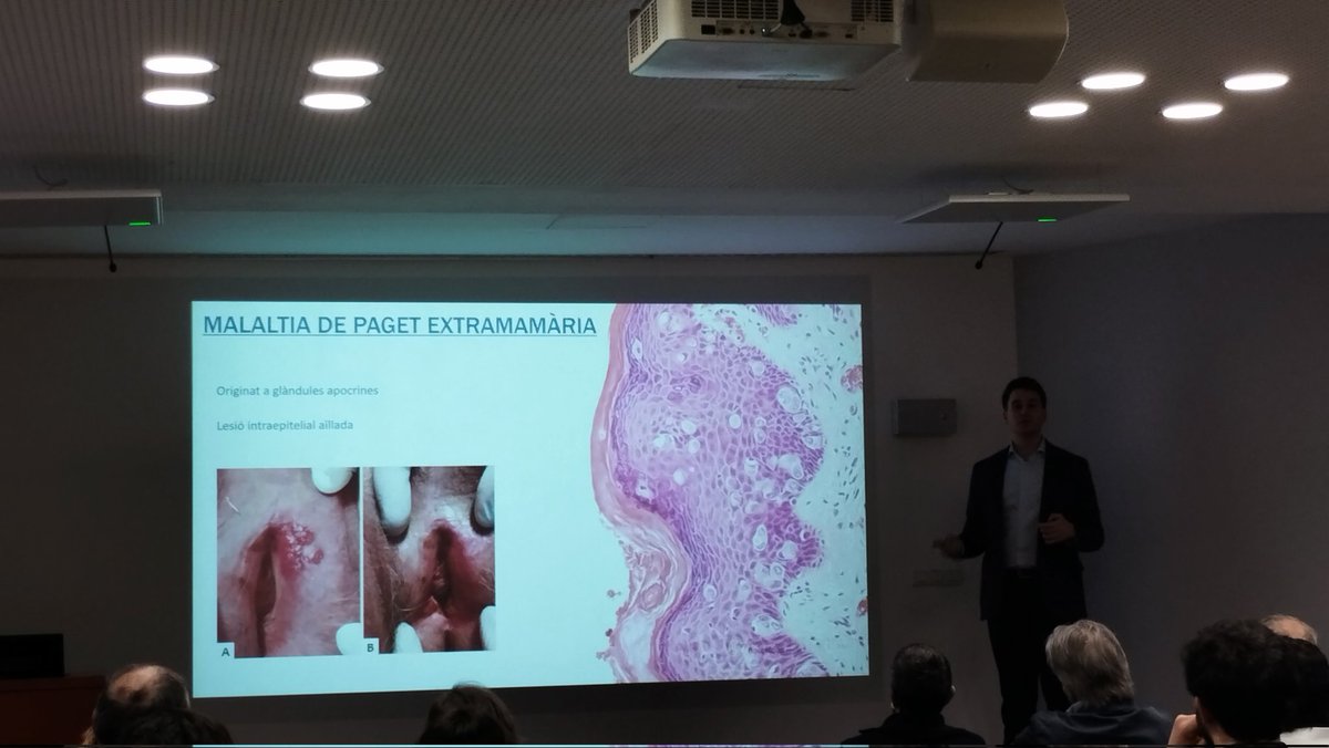 scurologia's tweet photo. A continuació a la #sessioresidents el Dr @JoanSureda ens presenta un cas molt interessant recalcant la importància del marge uretral positiu en pacients amb Cis vesical després de una cistectomia amb recidiva extravesical, enhorabona per la presentació!

@GRUCSCU https://t.co/KrNX0AklDL