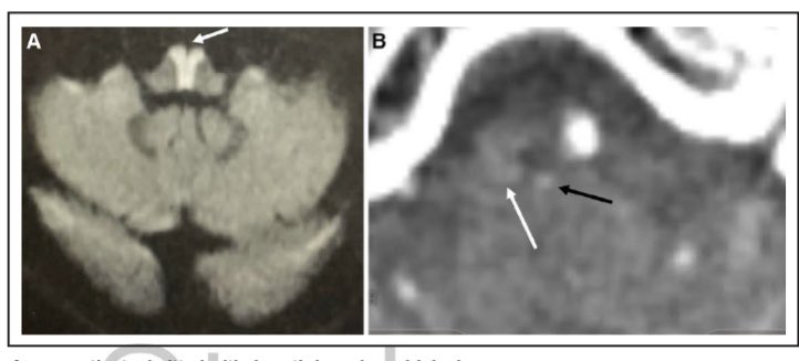 ShadiYaghi2's tweet photo. The “airpod” sign is published. It features occlusion of ASA supplying both medial medulla &amp; infarct of cortical spinal tracts, medial leminiscus, &amp; 12th nucleus. #MedTwitter #NeuroTwitter @StrokeAHA_ASA @eytanraz @shashank_agarMD @caseyalbin @MicieliA_MD https://t.co/XTIz9m97E7 https://t.co/CGDyTDKd2R