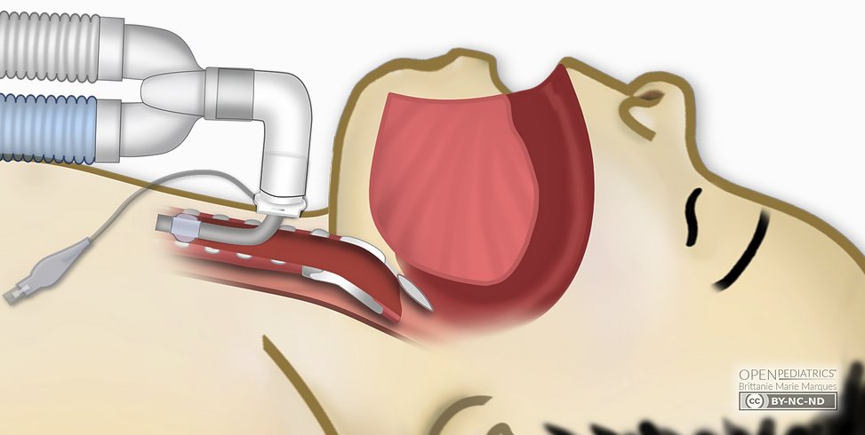 Have you seen our new Clinical Image Library? We have almost a dozen images related to Medical Technologies. The images are free to use in non-commercial work with proper citation. openpediatrics.org/clinicalimagel… #MedEd